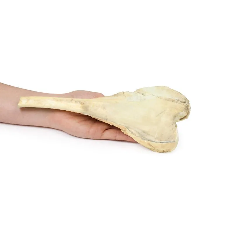 3D Printed Osteosarcoma of Femur